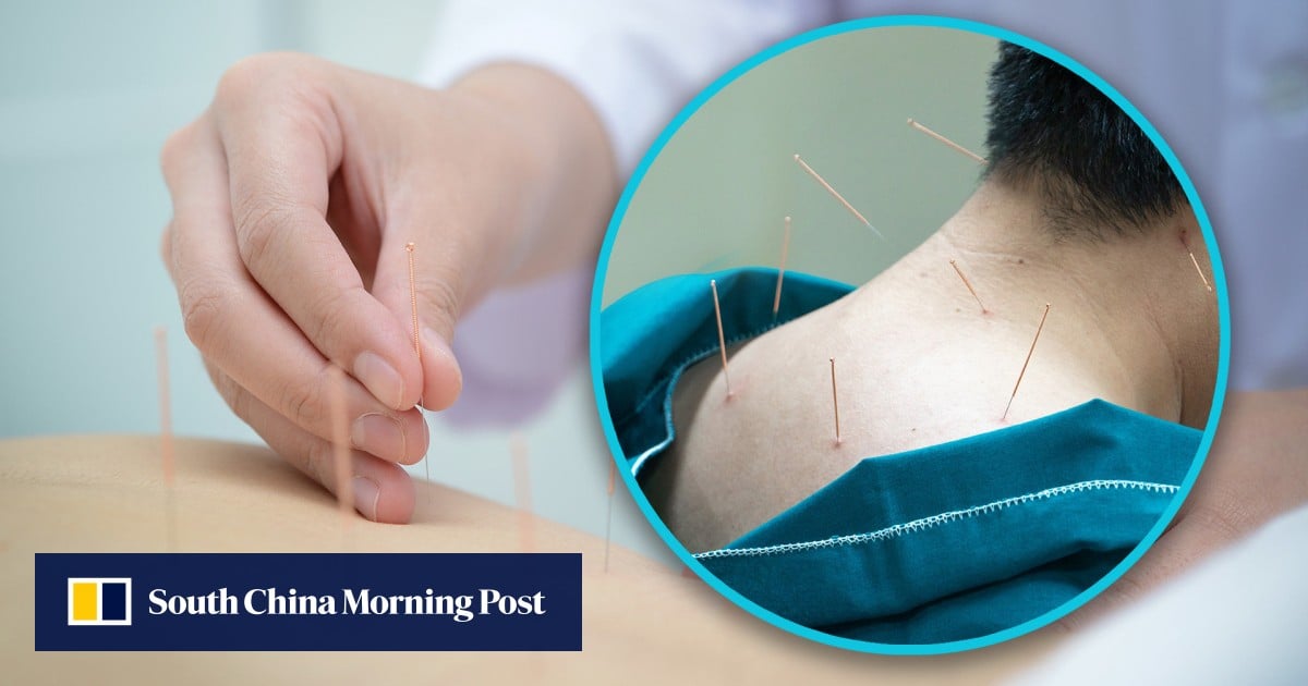 Chinese man visits cybercafe for acupuncture, ends up in ICU with punctured lungs 1 34a1a8bf 5489 4bad ac92 96e8c4273171 3e086791