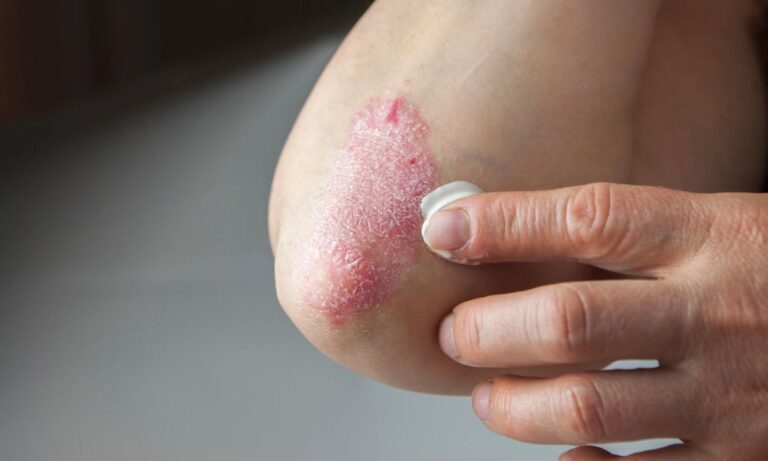 229379-plaque-psoriasis-2.jpg