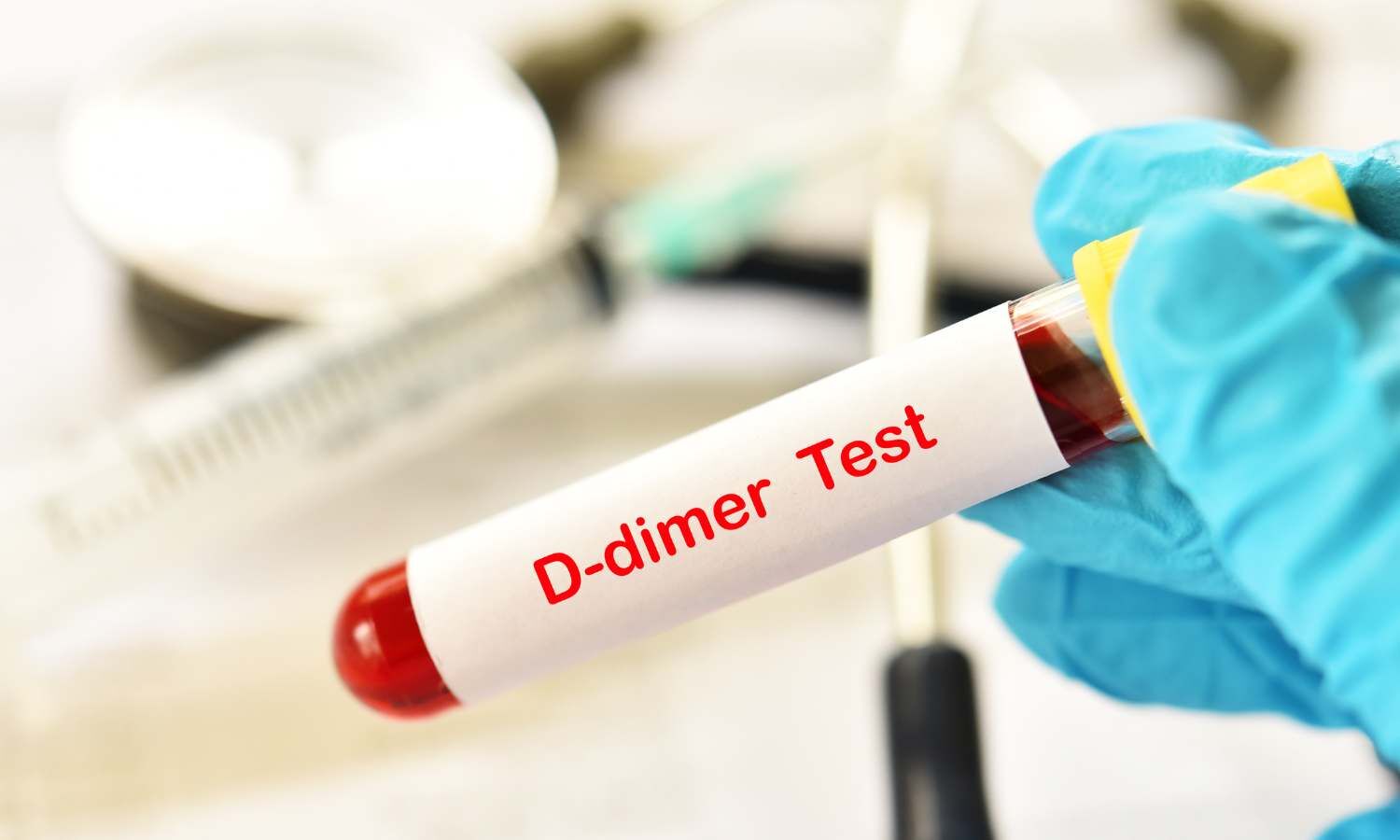 201442-d-dimer-blood-test.jpg