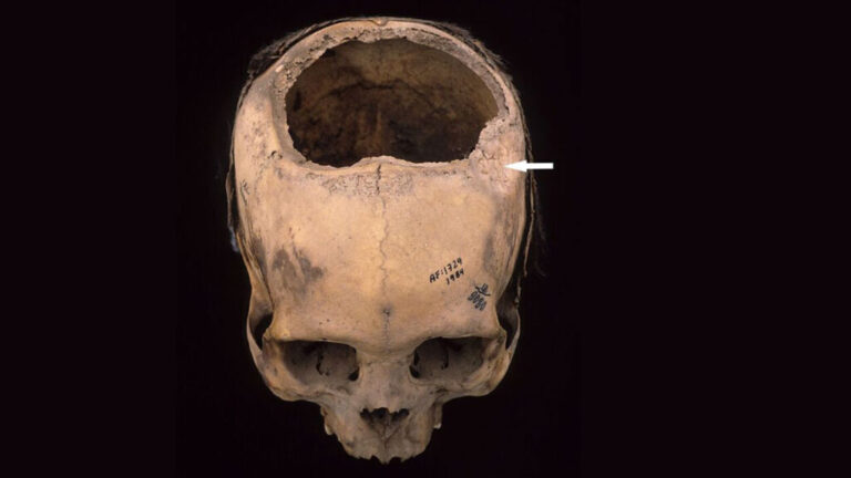 trepanation_16x9-1024x576.jpg