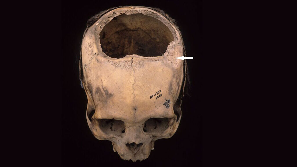 trepanation_16x9-1024x576.jpg